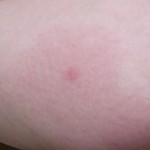 蚊に刺されて大きく腫れる原因は蚊アレルギー？体質？蚊刺過敏症の症状とは